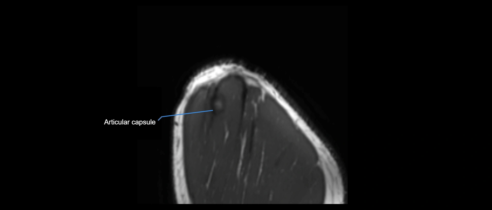 shoulder ligaments sagittal  cross sectional anatomy 3T MRI AI enhanced radiology image -img-00001-00059.webp